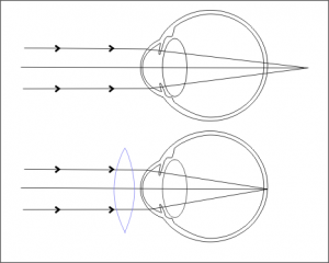 1724296822 hypermetropia