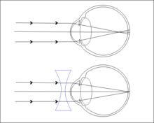 Myopie - Krátkozrakost